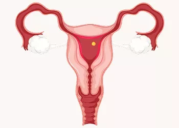 Adenomyosis: Symptoms, Diagnosis, and Treatment