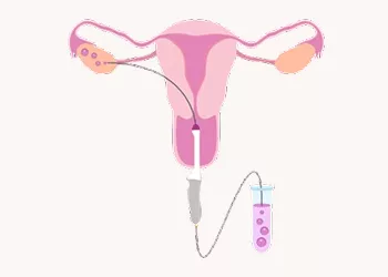 Artificial Insemination: What It Is, How It Works, and Who Needs It