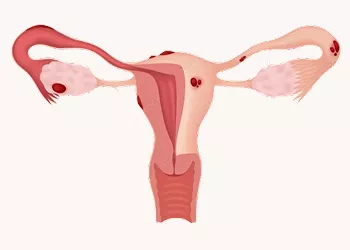 Endometriosis: Things You Need To Know