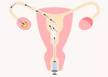 IVF vs IUI: Which Fertility Treatment Is Right for You?