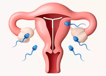 Pregnancy After Mirena Removal