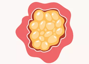 Ovarian Cysts: Causes, Symptoms, and Treatment Options