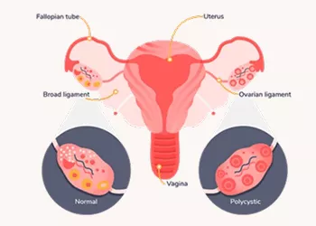 PCOD: Symptoms, Causes, and Treatment Options for Women