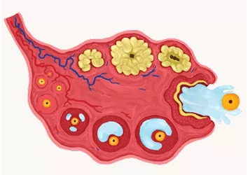 Primary Ovarian Insufficiency (POI): Causes, Symptoms and Treatment