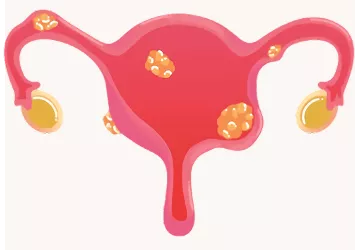 Uterine Fibroids: Symptoms, Causes, and Treatment Options