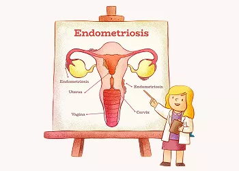Everything About Endometriosis Stages (1-4)